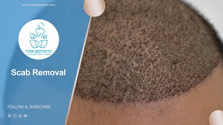 Scab Removal After Hair Transplant 30 Minutes  Turk Aesthetic [upl. by Erastus83]