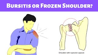 3 Difference Between Bursitis And Frozen Shoulder Pain you must know [upl. by Oicnecserc]