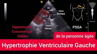 Hypertrophie Ventriculaire Gauche HVG Left Ventricular Hypertrophy Échographie [upl. by Oiracam]