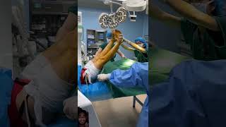 Operation theatre lithotomy positionMBBS surgery sohorts shortsyoutube operationpolo [upl. by Yorle716]