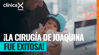 El diagnóstico de craneosinostosis logra estar bajo control gracias a una cirugía  Clínica X [upl. by Ahsenyl]