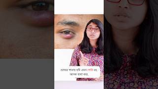 চোখের পাতায় অঞ্জনি হলে করণীয় [upl. by Aivatra45]