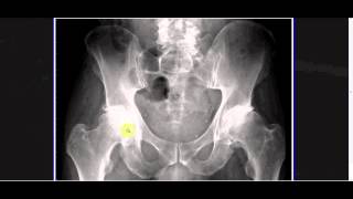 Interpreting XRays of the Pelvis Hip Joint and Femur [upl. by Ekrub]