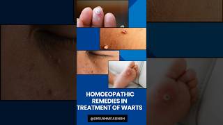 Warts treatment [upl. by Ahtelrac]