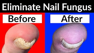 How to Use Funginix for Toenail Fungus [upl. by Adnamra]