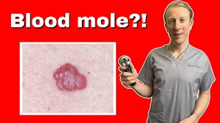 Haemangioma Adult Onset Doctor Explains Why Thats Not A Mole [upl. by Notnarb]