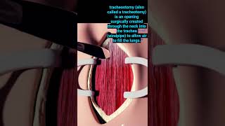 Tracheostomy Procedure doctor practical tracheotomy tracheostomy trendingshorts [upl. by Aun]