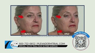 Smooth out your fine lines with Plexaderm for only 1495 [upl. by Renfred]