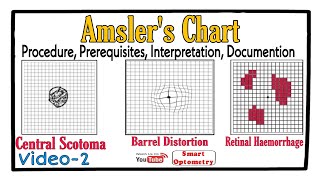 Amslers Chart Procedure Prerequisites Scotoma Interpretation Documention Video2 [upl. by Annnora943]