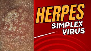 HERPES IN MALAYALAM  Symptoms Who What amp When To Test Treatments Fact Check Stages amp Testing [upl. by Glory363]