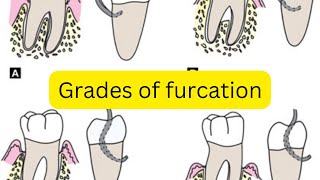 Grades of furcation involvement MADE EASY [upl. by Yanrahc]