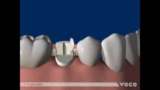 Universal adhesive Futurabond UPart 1212 Luting of root posts with a DCCC luting composite [upl. by Minni]