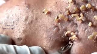 Acne amp Blackhead Treatment on his foreheadBlackhead Removal on forehead  Remove Blackhead [upl. by Thurman419]