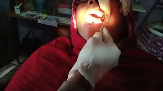 upper left side fast molars extraction and premolars RCT PROCESS step 1 [upl. by Nylirrehs]