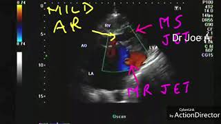 Echo mitral stenosis  MR  mild AR [upl. by Marozas]