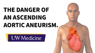 Surgeon describes an ascending aortic aneurysm  UW Medicine [upl. by Asilak748]