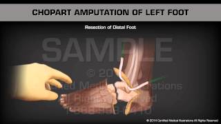 Chopart Amputation Left Foot [upl. by Paz438]