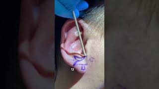 EAR REDUCTION SURGERY OTOPLASTY  DR TANVEER JANJUA  NEW JERSEY [upl. by Pressey]