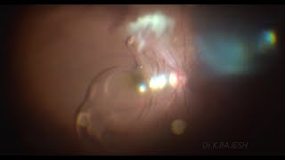 IOL Drop and Sulcus IOL Fixation  Video 120 [upl. by Acsisnarf]