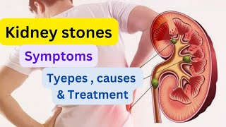 Everything you need to know about kidney stone [upl. by Marleen57]