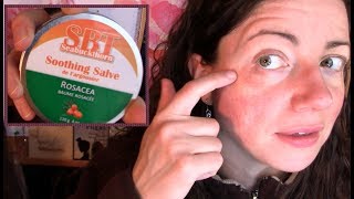 Skin Reaction Disaster How I Recovered My Rosacea Prone Face not sponsored  Rosy JulieBC [upl. by Alyakcim]