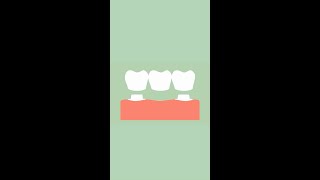 Dental Implant vs Bridge [upl. by Hadleigh]