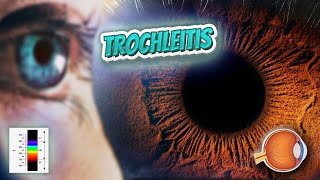 Trochleitis Your EYEBALLS 👁️👁️💉😳💊🔊💯✅ [upl. by Radack]