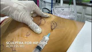 Sculptra filler treatment for hip dips  Ageless MD [upl. by Ahterod]