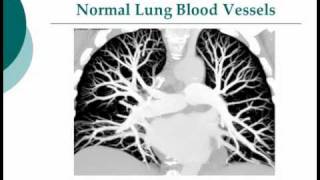 Your Radiologist Explains Computed Tomography CT Pulmonary Embolism [upl. by Idnahk768]