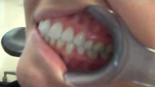 Intraoral Camera Demonstration [upl. by Clellan374]