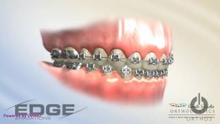 Decalcification  Due to poor hygiene with braces white spots [upl. by Zicarelli454]