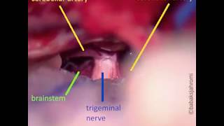 Trigeminal Neuralgia [upl. by Airotal]