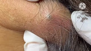 sebaceous cyst behind the neck HoangMySpa78 [upl. by Louisa262]