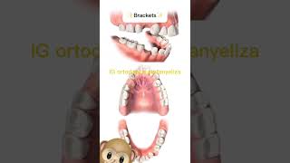 Extractions in orthodontics orthodontictips ортодонтия kieferorthopädie ortodonzia orthodontie [upl. by Namyw715]