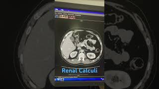 CECT Abdomen Only IV Contrast [upl. by Aldo42]