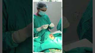 Excision of Ranula  Surgery  Ranula treatment  Dr Ranjana Butola [upl. by Nnyla]