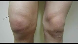 كيف نتخلص من ماء الركبة وإنصبابهاKnee joint effusion الدكتور عقبة نافع الناصري Uqba N Yousif [upl. by Imnubulo]