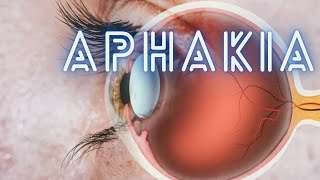 Aphakia  Ophthalmology Lecture [upl. by Raybin49]