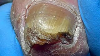 Curly ingrown nails poor onychomycosis【Pedicure Master Lin Jun】 [upl. by Cindie]