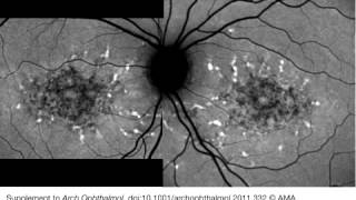 Centrifugal Expansion of Fundus Autofluorescence Patterns in Stargardt Disease Over Time Part 1 [upl. by Anawek]