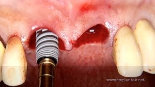 Immediate tooth replacement Nobel ActiveNobel Biocare [upl. by Yelyk663]