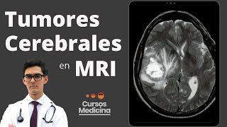 Reconocer Tumores Cerebrales en Resonancia Magnética para Estudiantes de Medicina [upl. by Enid989]