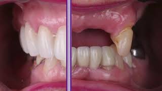 Before and After Partial Denture Replaced by a Zirconia Lingual with Ceramic Bridge Transformation [upl. by Dduj]