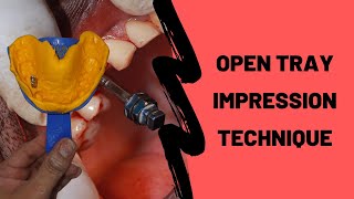 How To Take an Open Tray Implant Impression DEMO [upl. by Arekahs240]