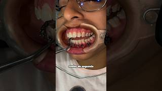 Ella necesitaba extracciones 🤓 dentista brackets ortodoncia [upl. by Eiresed835]