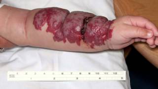 Infantile Hemangiomas aka “Strawberry” Birthmarks [upl. by Notned856]