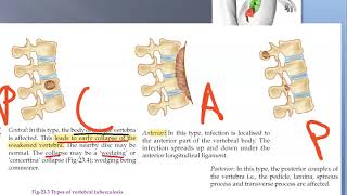 Orthopedics Potts spine Paraplegia Tuberculosis of Bone Tuberculous Osteomyelitis Minerva Jacket [upl. by Oreste]