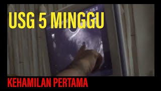 Kehamilan Pertama USG 5 minggu 1 bulan Positive Test Pack [upl. by Weinshienk]