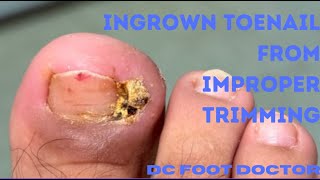 Ingrown Toenail Removal After Improper Trimming [upl. by Merrilee]