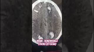 Brain hemorrhage stork Ncct head 🩻 Brain pathology 🧠 CT SCANct anatomy viral trending [upl. by Enyrehtak543]